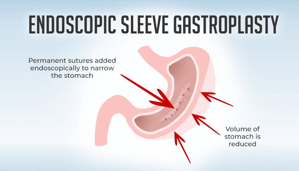 Pictorial representation of endoscopic sleeve gastroplasty