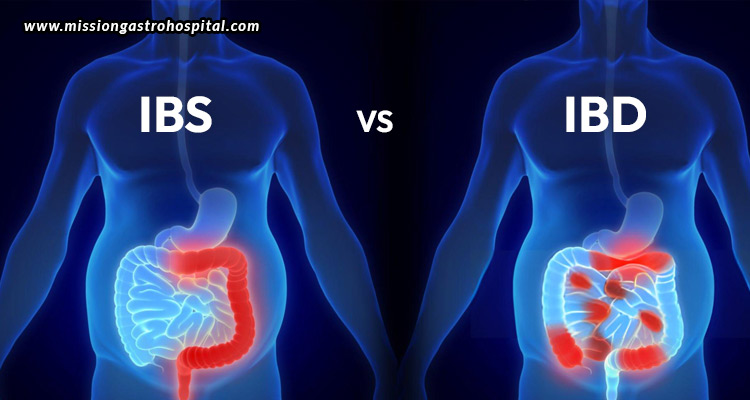 IBS-Vs-IBD-Understanding-The-Differences