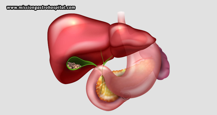 Gallstones-Symptoms-Treatment-And-Prevention