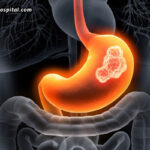 Early-Warning-Signs-Of-Stomach-Cancer