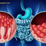 Understanding-Coeliac-Disease-Symptoms-Diagnosis-&-Management