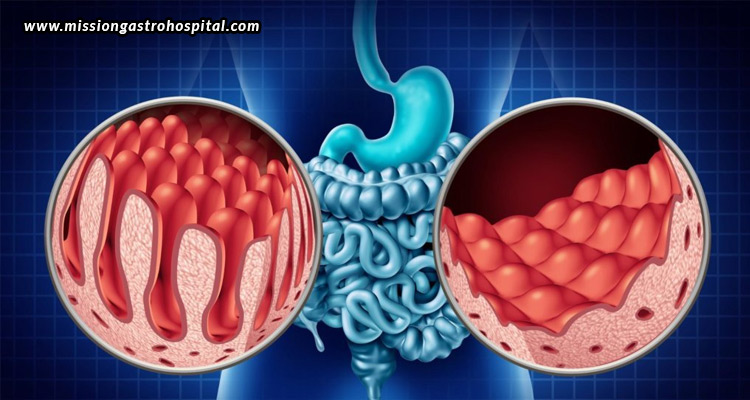 Understanding-Coeliac-Disease-Symptoms-Diagnosis-&-Management