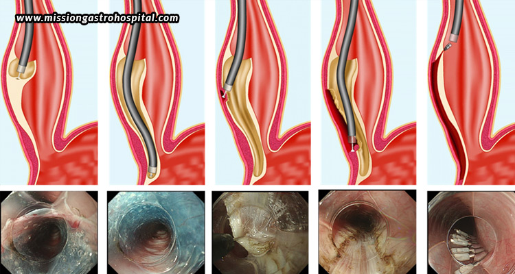 How-POEM-Is-Revolutionizing-The-Treatment-Of-Swallowing-Disorders