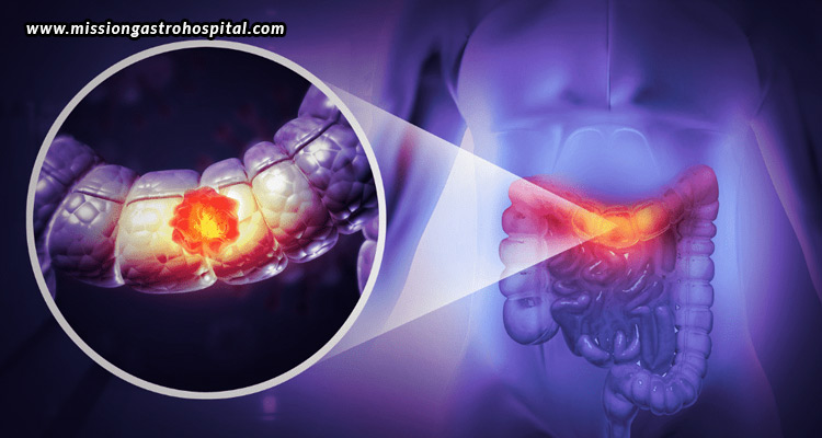 Colonoscopy-And-Cancer-Prevention