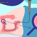 Colonoscopy-Myths-Debunked