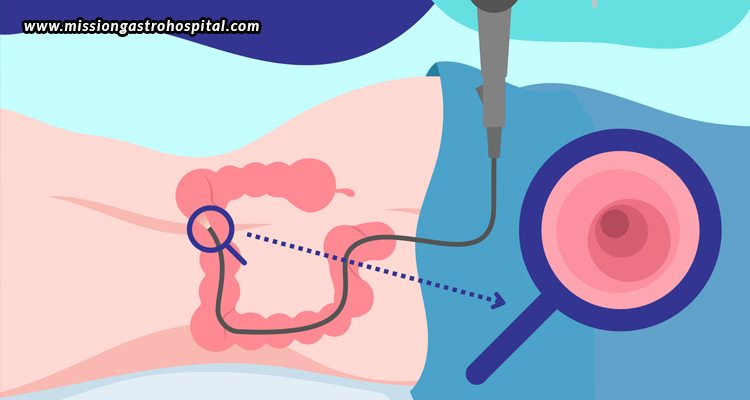 Colonoscopy-Myths-Debunked