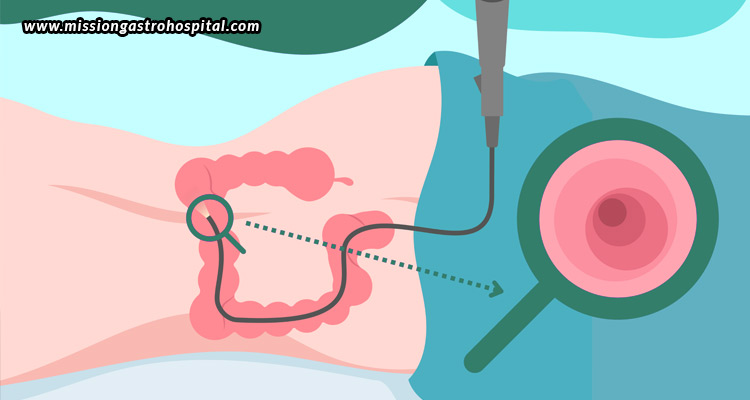 Colonoscopy-For-Women-Unique-Considerations