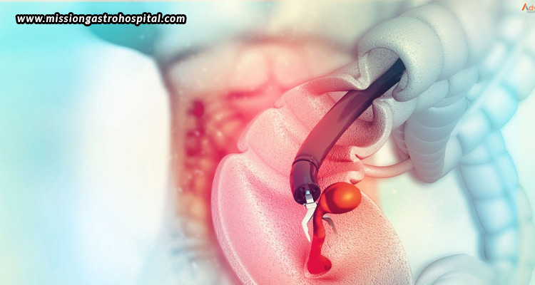 How-Frequently-Should-You-Undergo-A-Colonoscopy