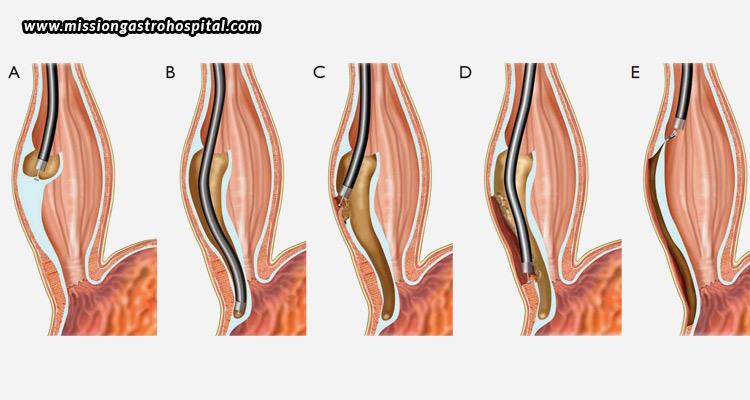 Understanding-The-Risks-And-Complications-Associated-With-POEM