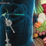 Diet-After-Gallbladder-Removal-What-to-Eat,-Avoid-&-Recover-Faster
