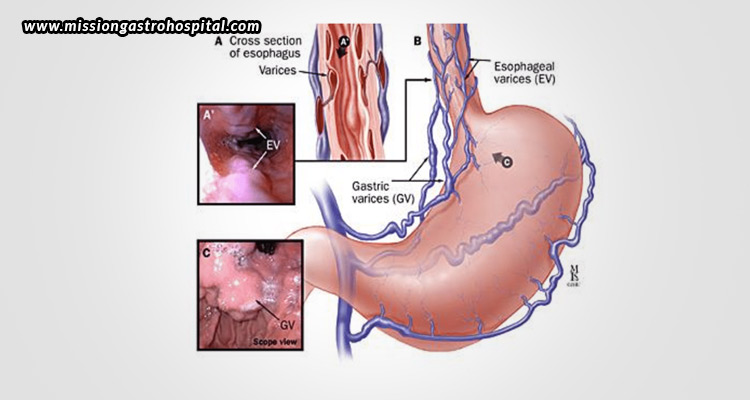 What-Are-Esophageal-Varices-Causes,-Symptoms,-Diagnosis,-and-Treatment-Explained