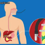 How-ERCP-Helps-Diagnose-And-Manage-Pancreatitis
