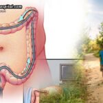 Life-After-Colonoscopy