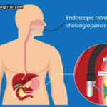 ERCP-For-Jaundice--Is-It-Helpful