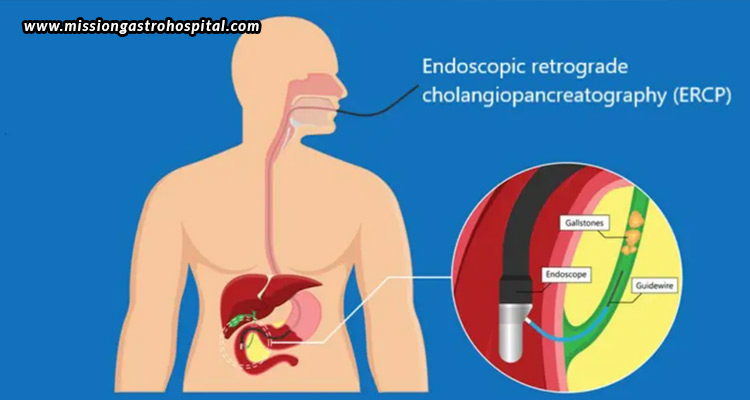 ERCP-For-Jaundice--Is-It-Helpful