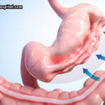 Who-Is-A-Good-Candidate-For-Endoscopic-Sleeve-Gastroplasty