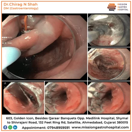 ercp in ahmedabad