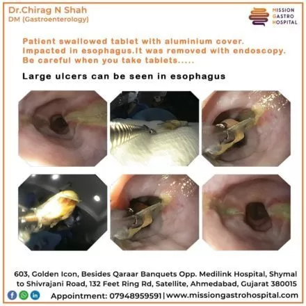 ercp in ahmedabad