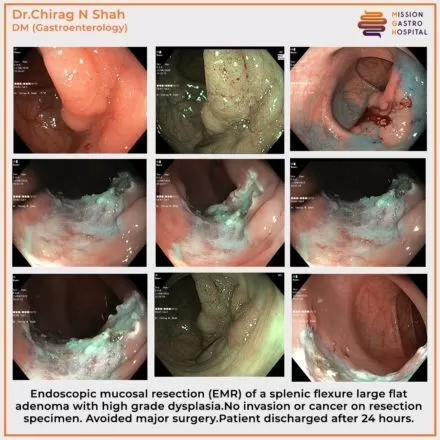 best colonoscopy doctors in ahmedabad