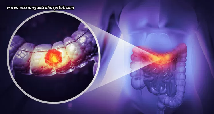 Colonoscopy-And-Cancer-Prevention