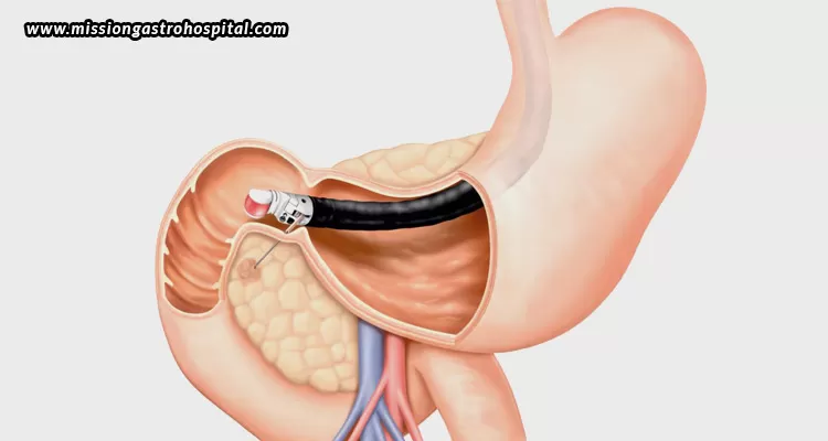 ERCP-What-To-Expect-And-How-To-Prepare
