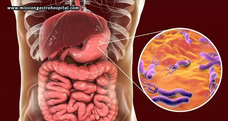 Helicobacter-Pylori-The-Bacteria-That-May-Be-Causing-Stomach-Discomfort