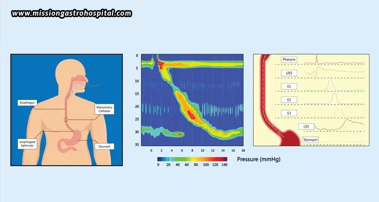 Oesophageal-Manometry-What-The-Test-Tells-You-About-Your-Swallowing-Problem