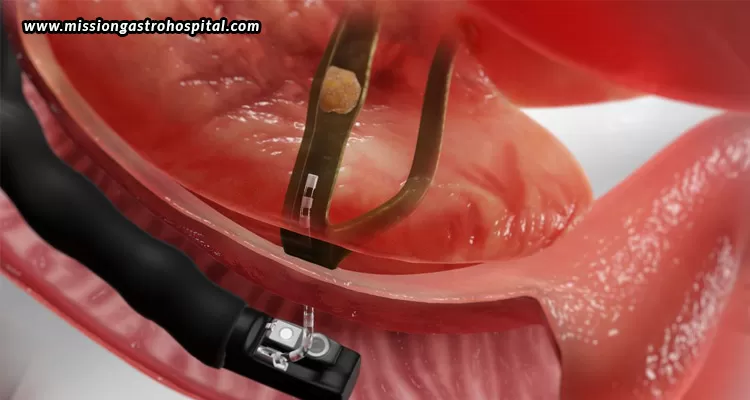How-ERCP-Can-Manage-Gallstones-And-Bile-Duct-Blockages