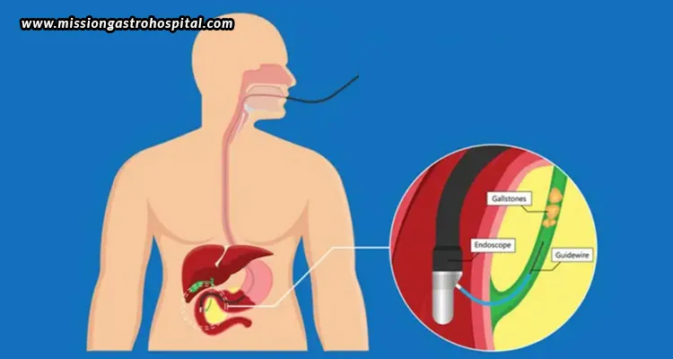 How-ERCP-Helps-Diagnose-And-Manage-Pancreatitis