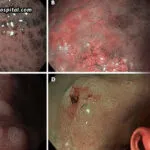 How-NBI-Endoscopy-Improves-Digestive-Tract-Abnormality-Detection
