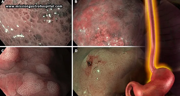 How-NBI-Endoscopy-Improves-Digestive-Tract-Abnormality-Detection