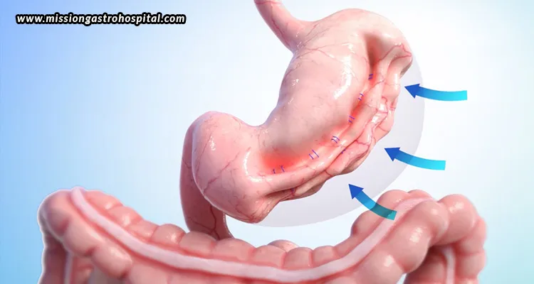 Who-Is-A-Good-Candidate-For-Endoscopic-Sleeve-Gastroplasty