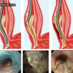 Mission-Gastro-Hospital-Specialized-Gastroenterology-Care-For-POEM